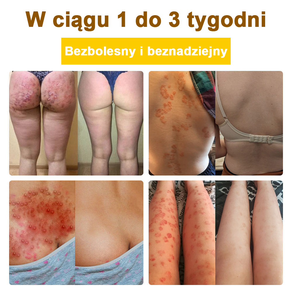 ✅flysmus™ Krem leczniczy z jadem pszczelim🐝: Leczenie egzemy, łuszczycy, trądziku, trądziku różowatego, infekcji grzybiczych, brodawek✅