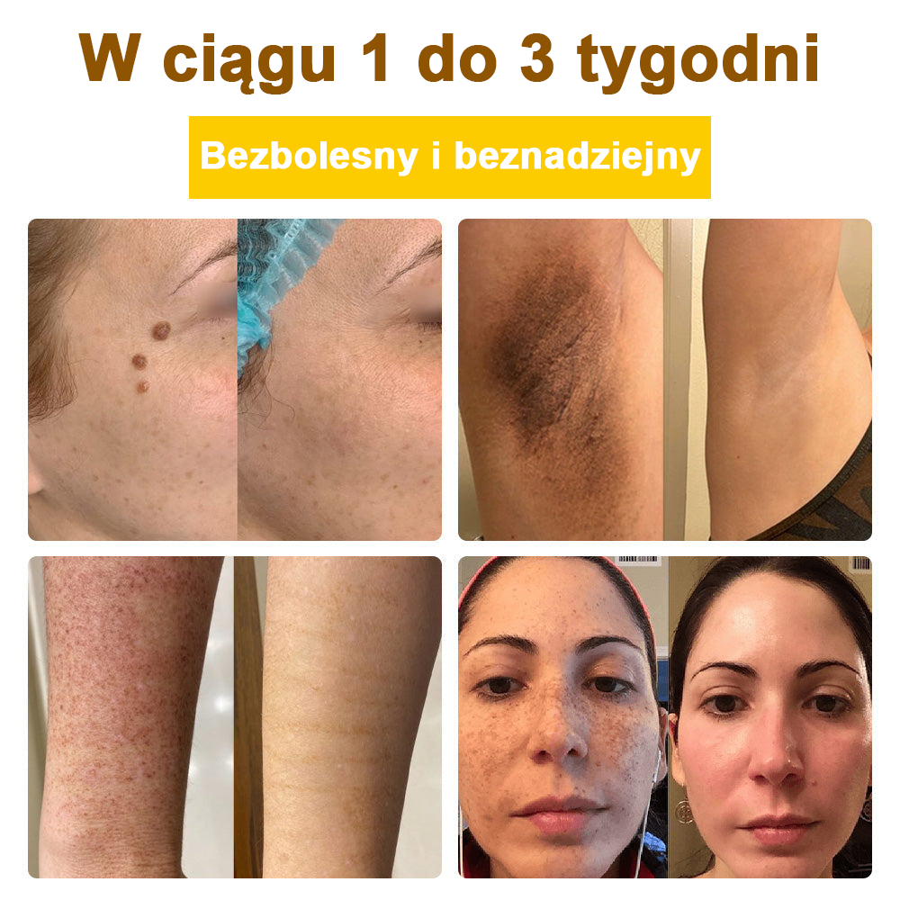 ✅flysmus™ Krem leczniczy z jadem pszczelim🐝: Leczenie egzemy, łuszczycy, trądziku, trądziku różowatego, infekcji grzybiczych, brodawek✅