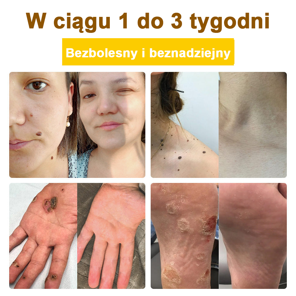 ✅flysmus™ Krem leczniczy z jadem pszczelim🐝: Leczenie egzemy, łuszczycy, trądziku, trądziku różowatego, infekcji grzybiczych, brodawek✅