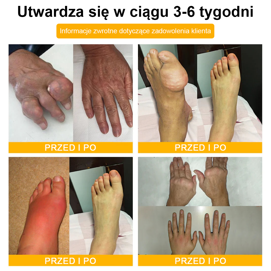 🐝TLOPA® Toksyna botulinowa i jad pszczeli Krem przeciwbólowy do gojenia kości🐝