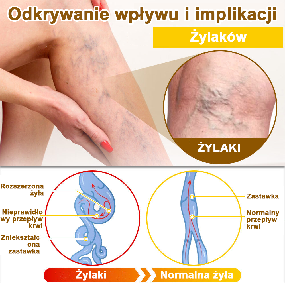 ✅flysmus™ Krem leczniczy z jadem pszczelim🐝: Leczenie egzemy, łuszczycy, trądziku, trądziku różowatego, infekcji grzybiczych, brodawek✅