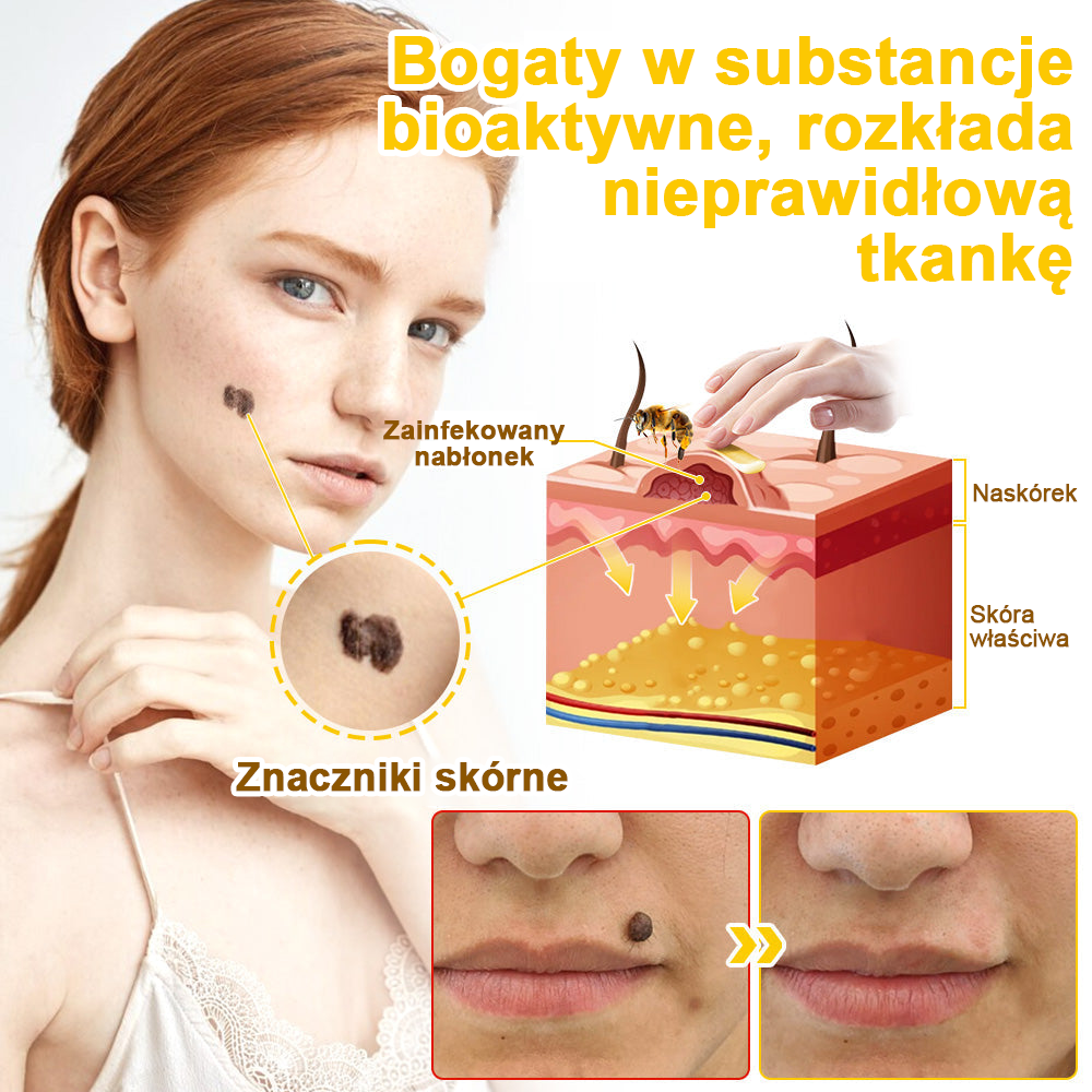 ✅flysmus™ Krem leczniczy z jadem pszczelim🐝: Leczenie egzemy, łuszczycy, trądziku, trądziku różowatego, infekcji grzybiczych, brodawek✅