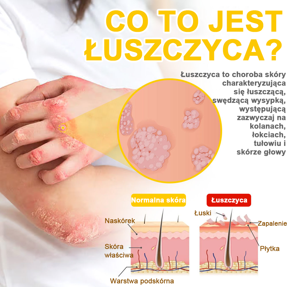 ✅flysmus™ Krem leczniczy z jadem pszczelim🐝: Leczenie egzemy, łuszczycy, trądziku, trądziku różowatego, infekcji grzybiczych, brodawek✅