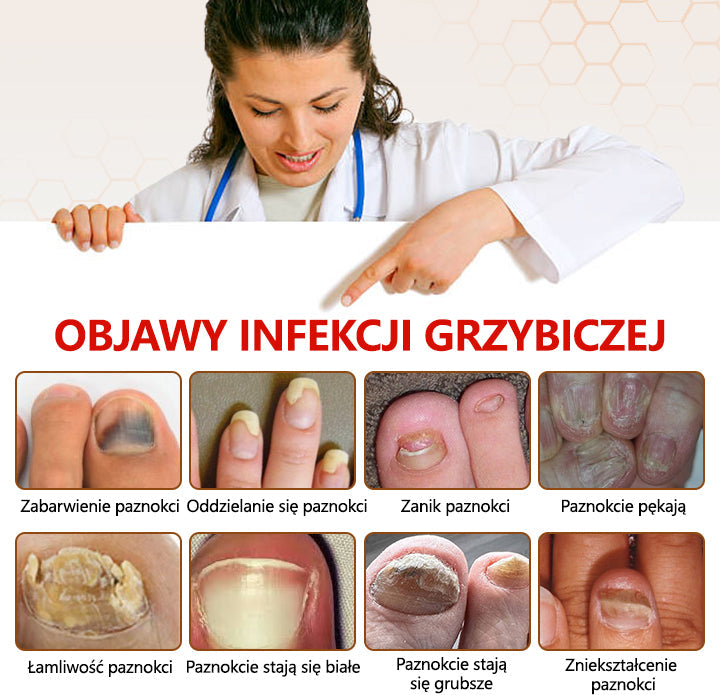 Spray z jadem pszczelim – skuteczny w leczeniu infekcji grzybiczych i zapalenia paznokci🎁🎁🎁