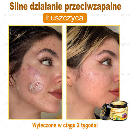 ΑPΚΑPK™ Jad Pszczoły Kompleksowy Krem🥇🥇pomaga w leczeniu problemów skórnych, takich jak: zmarszczki, blizny, plamy pigmentacyjne, rozstępy, trądzik, łuszczyca, egzema, zmiany skórne, podrażnienia, stany zapalne i inne problemy skórne🔥🔥