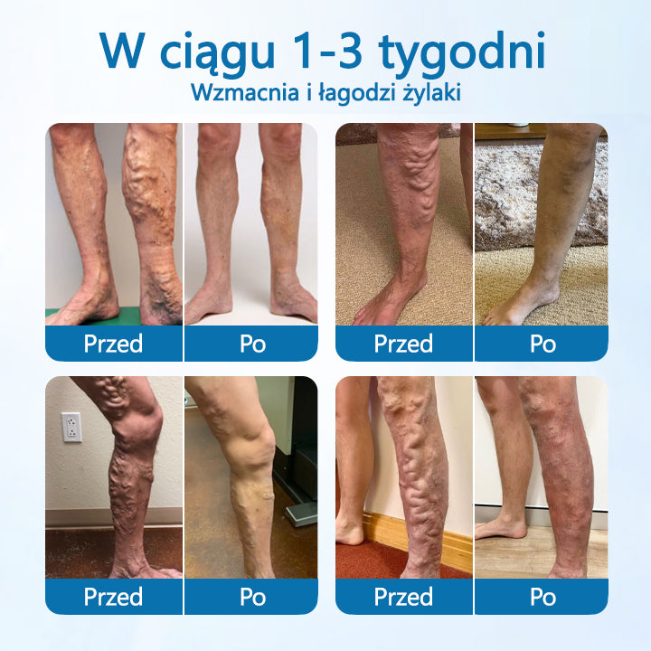 Timilk® VeinGuard Herbal Spray-✅ Klinicznie udowodniono, że eliminuje żylaki w zaledwie 7 dni!✅✅