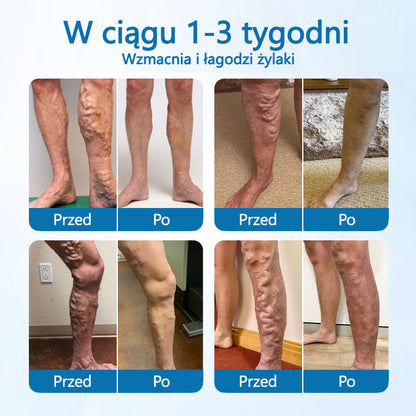 Timilk® VeinGuard Herbal Spray-✅ Klinicznie udowodniono, że eliminuje żylaki w zaledwie 7 dni!✅✅
