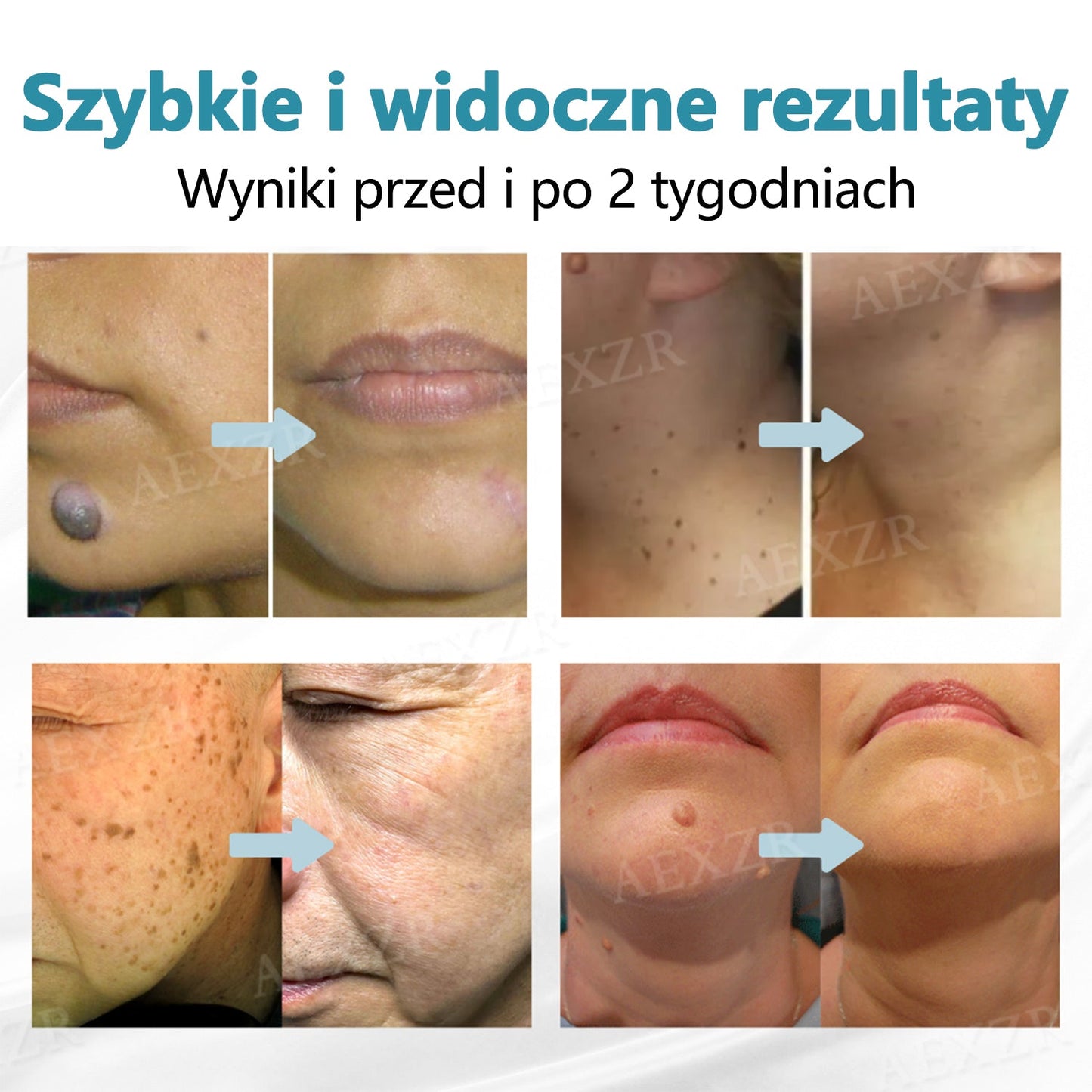 Cvreoz® nowy nieinwazyjny laser do usuwania pieprzyków i brodawek