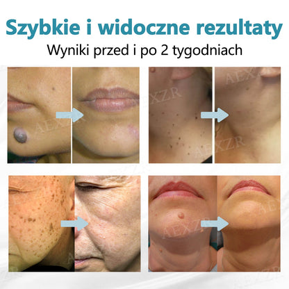 Cvreoz® nowy nieinwazyjny laser do usuwania pieprzyków i brodawek