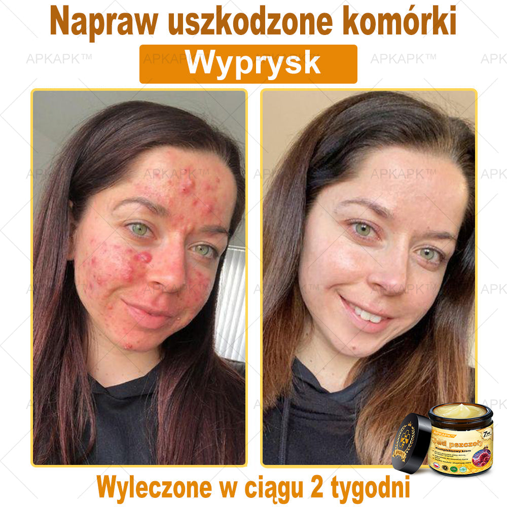 ΑPΚΑPK™ Jad Pszczoły Kompleksowy Krem🥇🥇pomaga w leczeniu problemów skórnych, takich jak: zmarszczki, blizny, plamy pigmentacyjne, rozstępy, trądzik, łuszczyca, egzema, zmiany skórne, podrażnienia, stany zapalne i inne problemy skórne🔥🔥