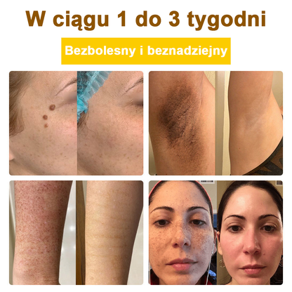 ✅flysmus™ Krem leczniczy z jadem pszczelim🐝: Leczenie egzemy, łuszczycy, trądziku, trądziku różowatego, infekcji grzybiczych, brodawek✅