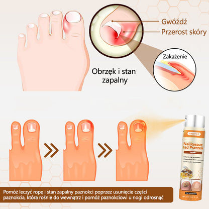 Spray z jadem pszczelim – skuteczny w leczeniu infekcji grzybiczych i zapalenia paznokci🎁🎁🎁