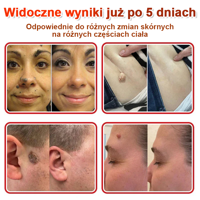 KUBOZN® Mikroigłowy Botaniczny Plaster na Usuwanie Brodawek Skórnych✨