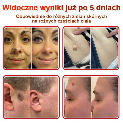 KUBOZN® Mikroigłowy Botaniczny Plaster na Usuwanie Brodawek Skórnych✨