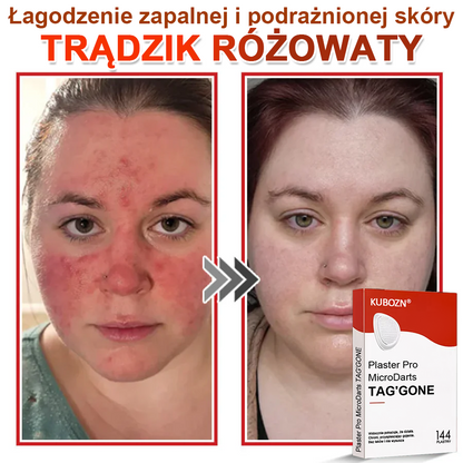 KUBOZN® Mikroigłowy Botaniczny Plaster na Usuwanie Brodawek Skórnych✨