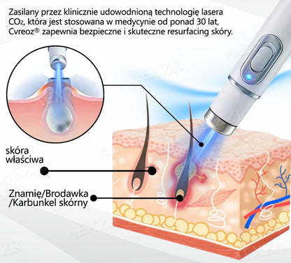 Cvreoz® nowy nieinwazyjny laser do usuwania pieprzyków i brodawek