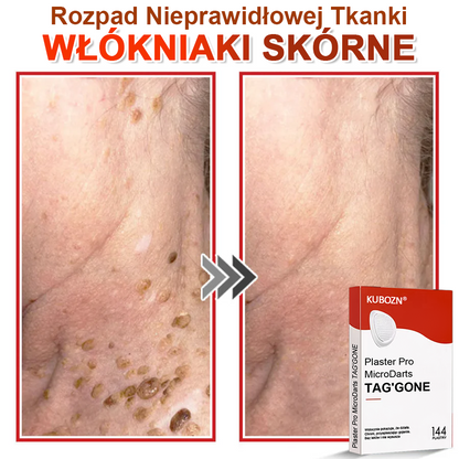 KUBOZN® Mikroigłowy Botaniczny Plaster na Usuwanie Brodawek Skórnych✨