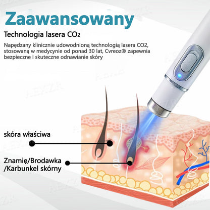Cvreoz® nowy nieinwazyjny laser do usuwania pieprzyków i brodawek